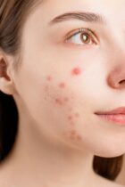 Acne Da Mulher Adulta Como Identificar E O Melhor Tratamento Charme Se