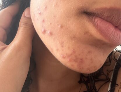 Espinha inflamada: desinflamei minha pele e me livrei da acne