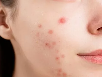 Acne da mulher adulta: como identificar e o melhor tratamento?