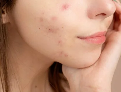 Pele com acne: mitos e verdades para se cuidar melhor